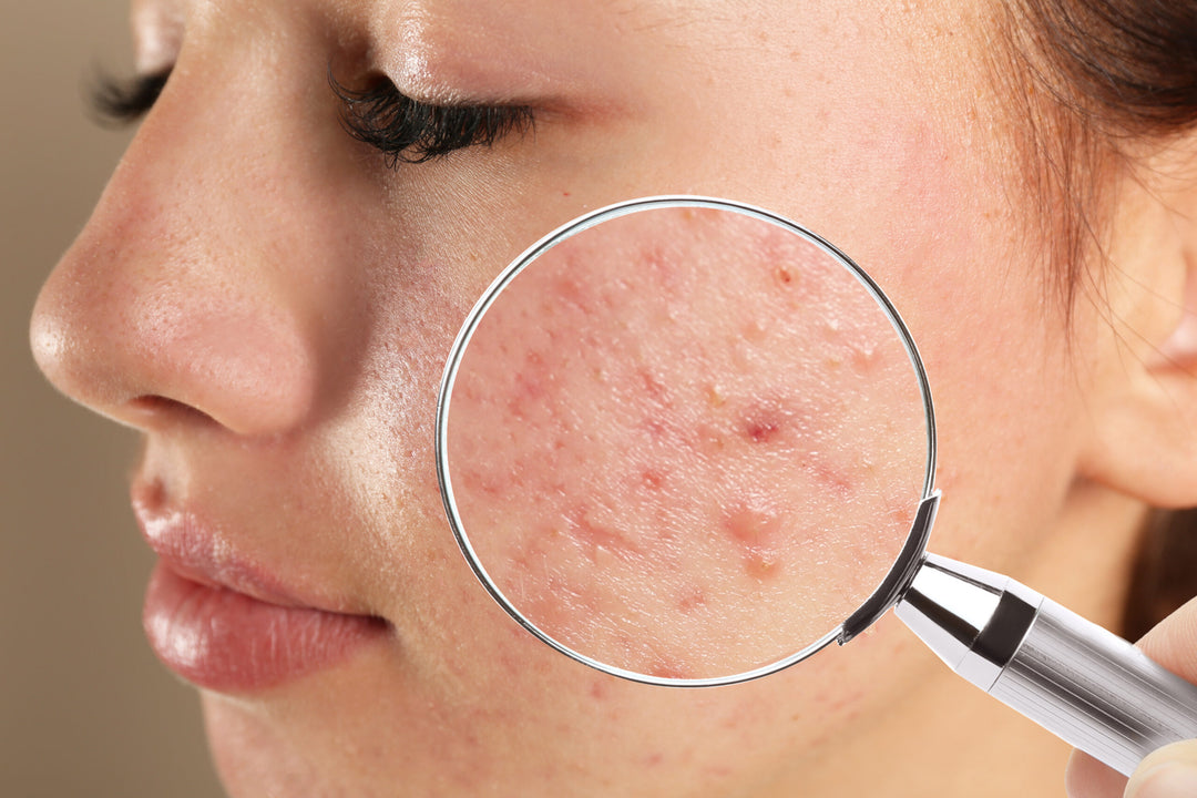Treating Acne for Providers<br>E-Book