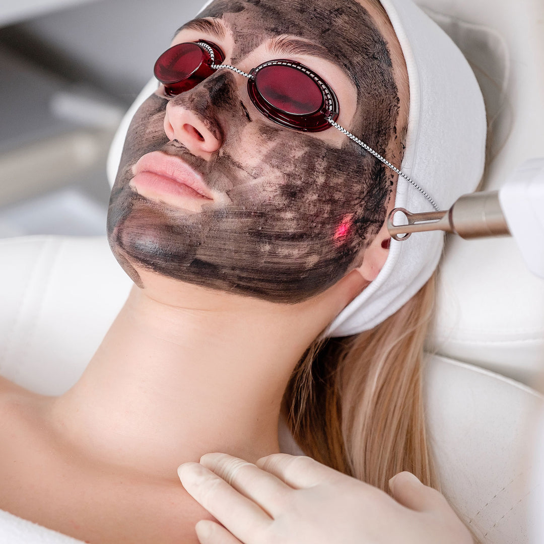 Carbon Laser Facial