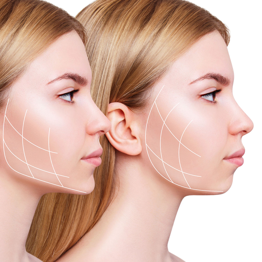Jawline Filler