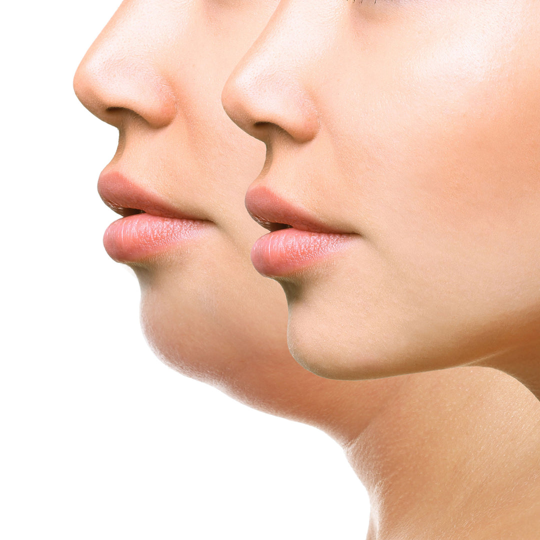 Kybella / Lipo Dissolve