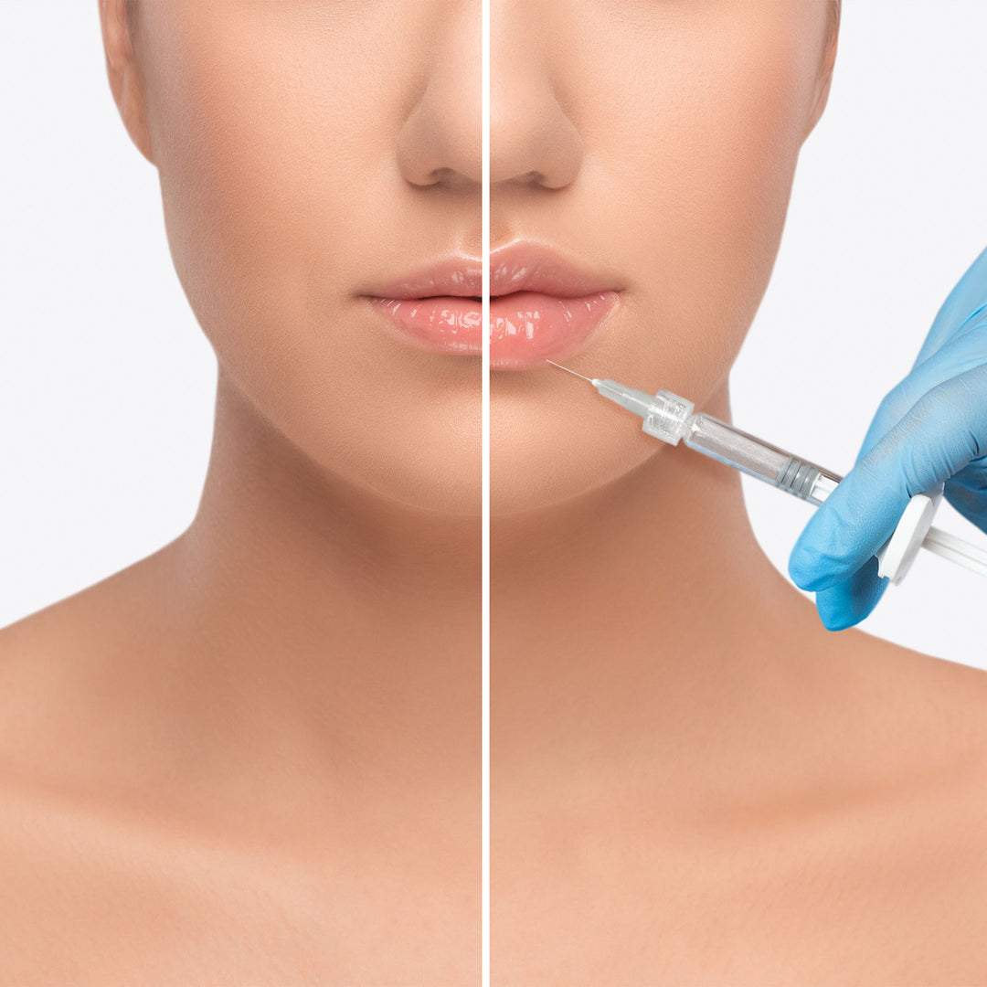 Restylane Kysse - 1 syringe
