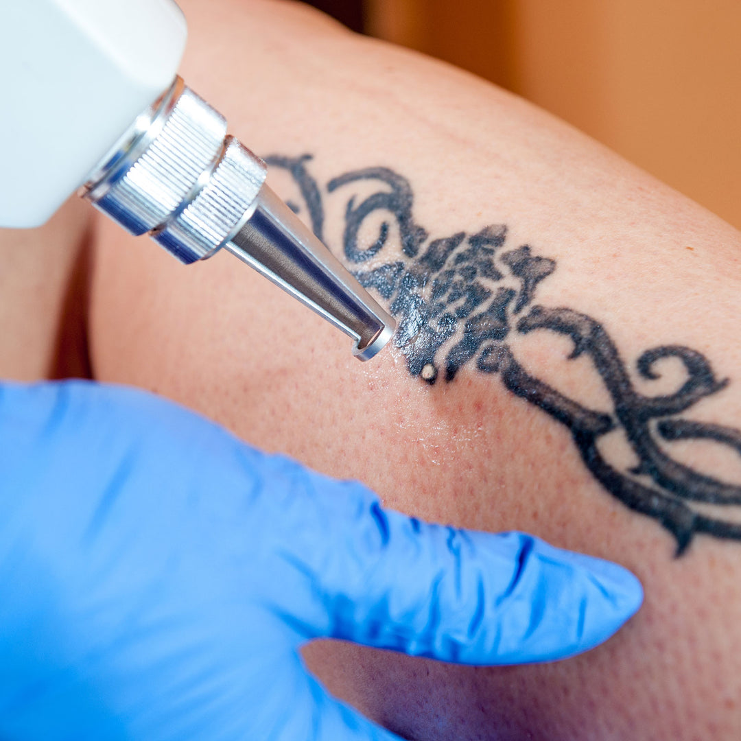 Tattoo Removal Deposit