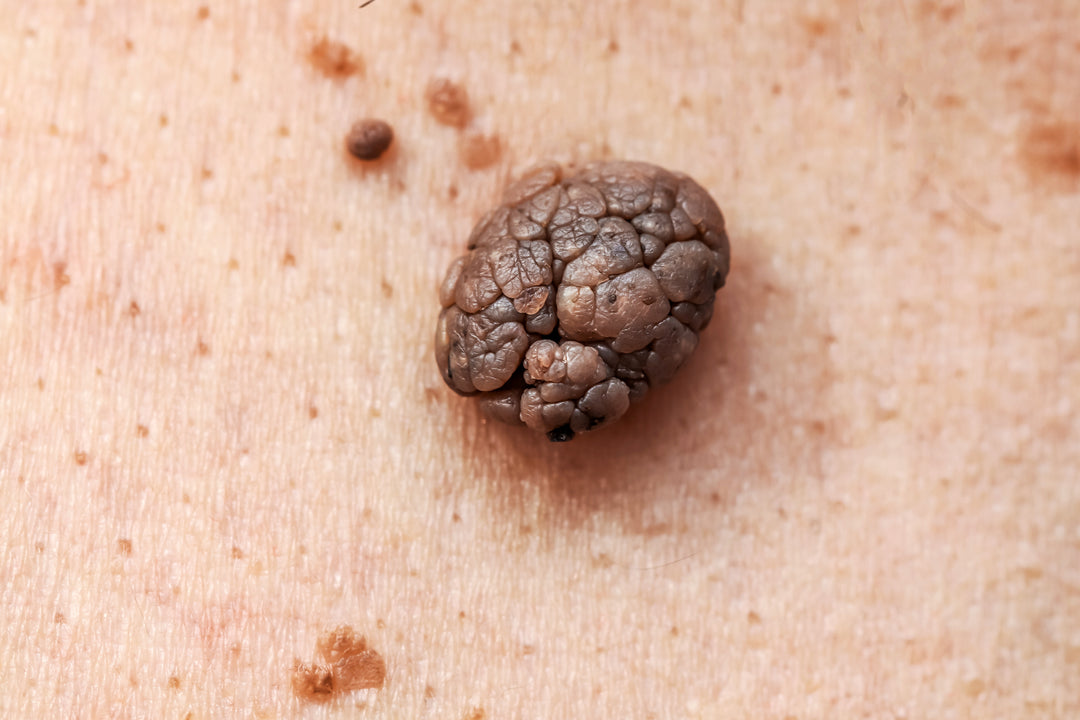 Skin Tag-DPN Removal